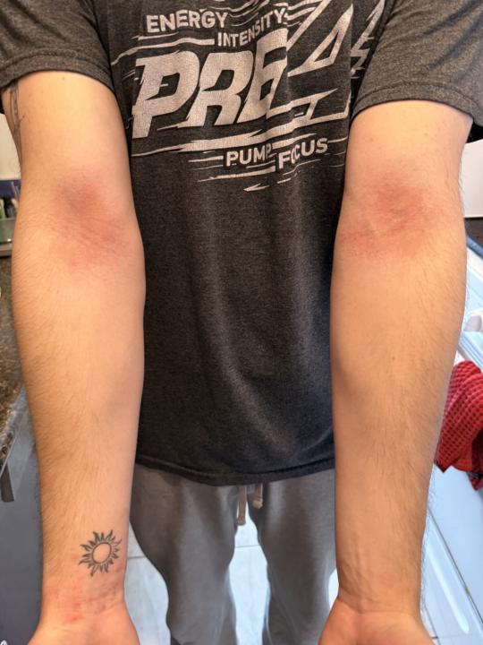 Eczema 