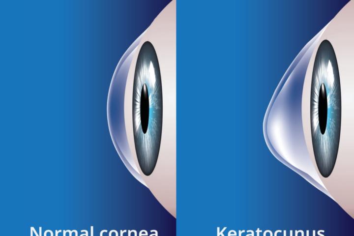 Reversing Keratoconus possible?
