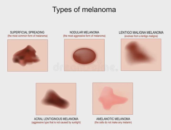 Types of Melanoma 