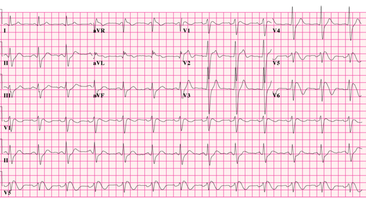 This ECG got a completely healthy 23-year-old banned from competitive sport. Why?