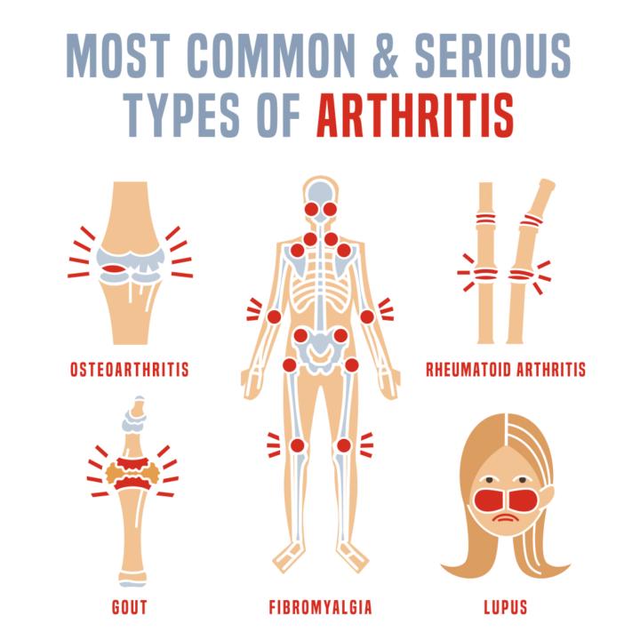 The Arthritis Chronicles: Unraveling the Mystery of Joint Pain!
