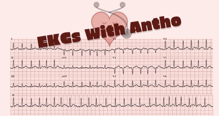 EKGs with Antho