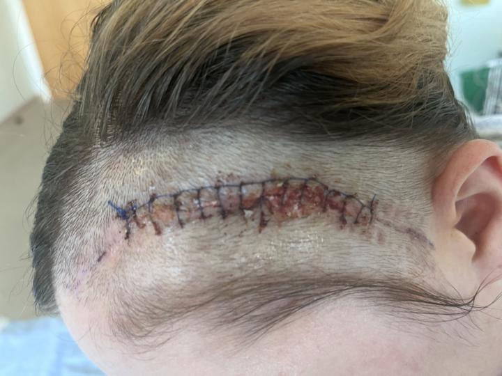 Don’t click if you don’t like stitches surgery wound reveal