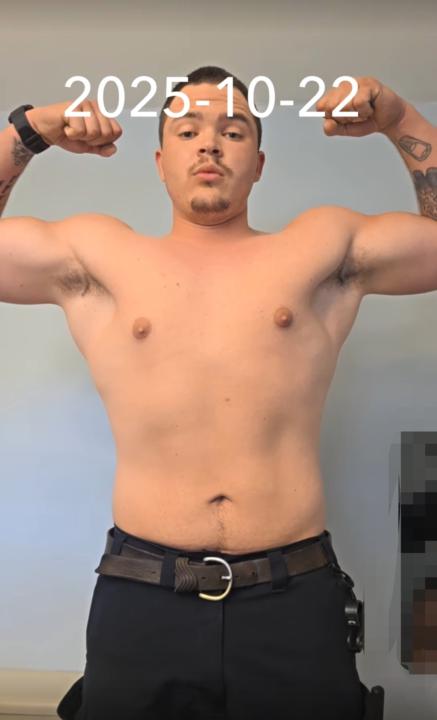 My Experience with Retatrutide (Personal Journey)