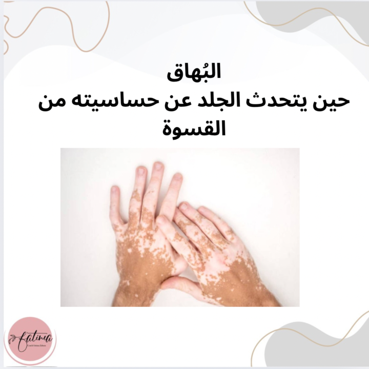 البُهاق… حين يتحدث الجلد عن حساسيته من القسوة