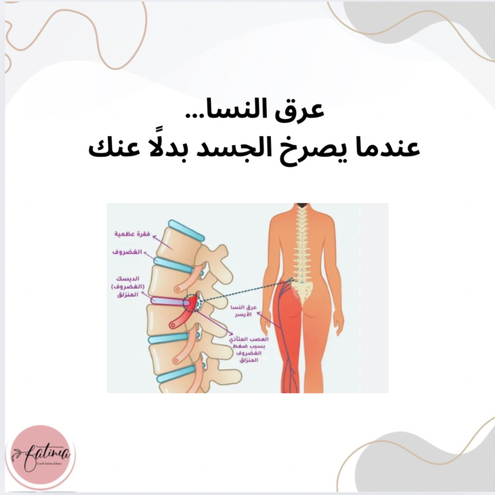 عرق النَّسا ليس مجرد ألم يمتد من أسفل الظهر إلى الساق