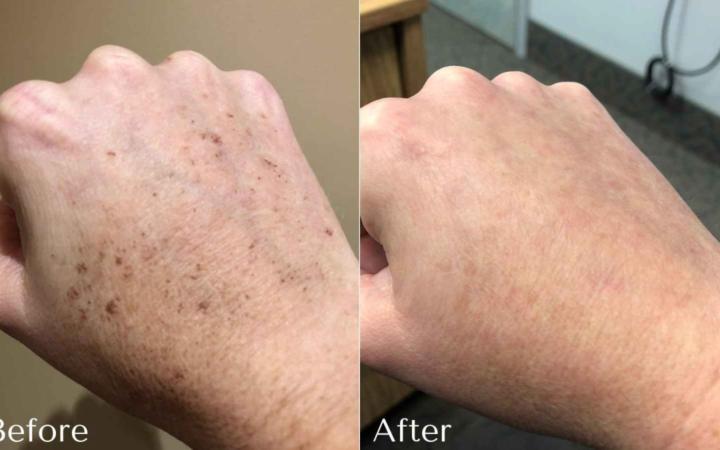 Age Spots: What's the Root Cause and How Can We Naturally Fade Them? ☀️