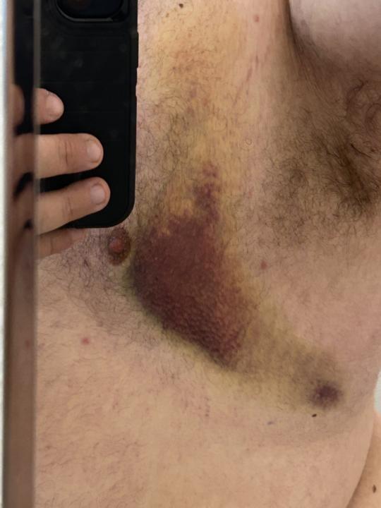 Torn Pec and and Recovery