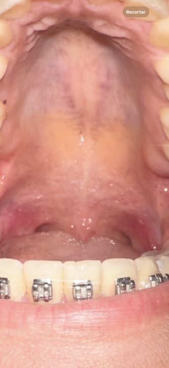 Assymetry, cross bite, cant 