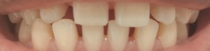 Mi proceso con el protector bucal 24/7