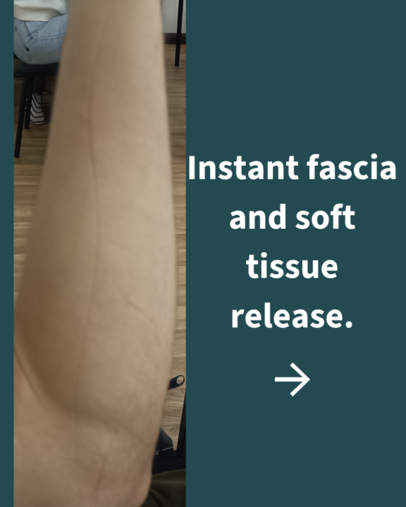 Stretch marks from the most effective technique yet.