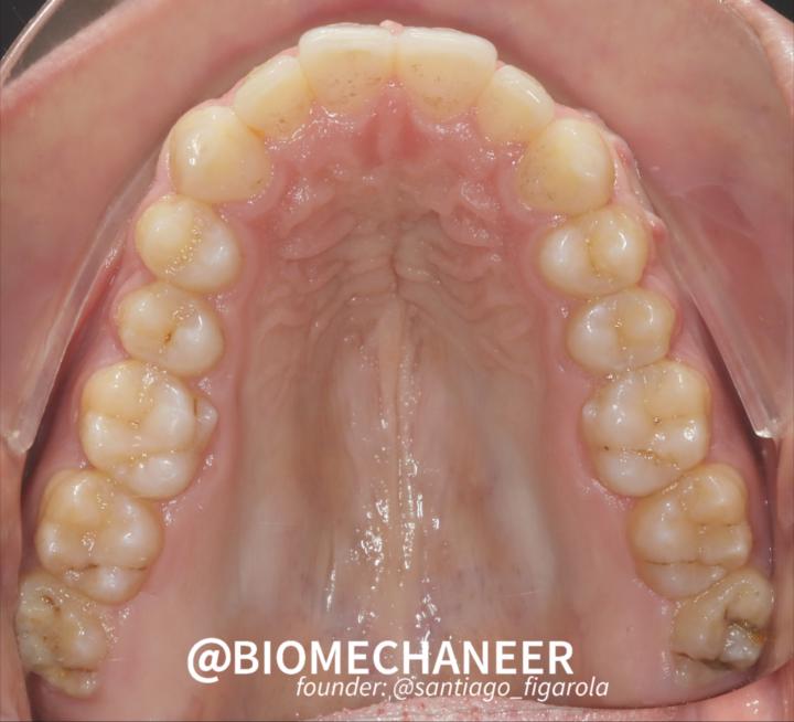 4.44 mm Palatal Expansion in 297 days (22M). My documented Journey.