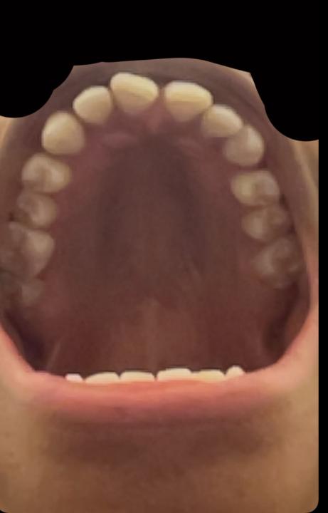 Is my Palate narrow ?