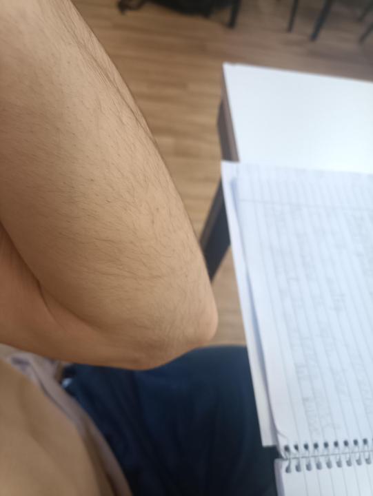 Unexpected soft tissue stretch marks: singing as an accelerator.