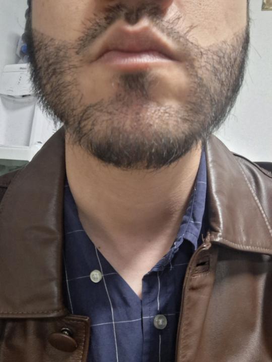 Patchy beard