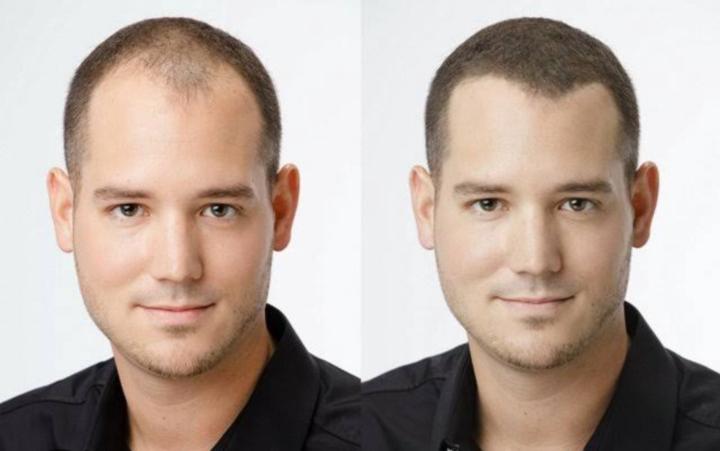 Best hair regrowth products