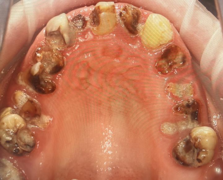 Kaaries kui Süsteemne Haigus