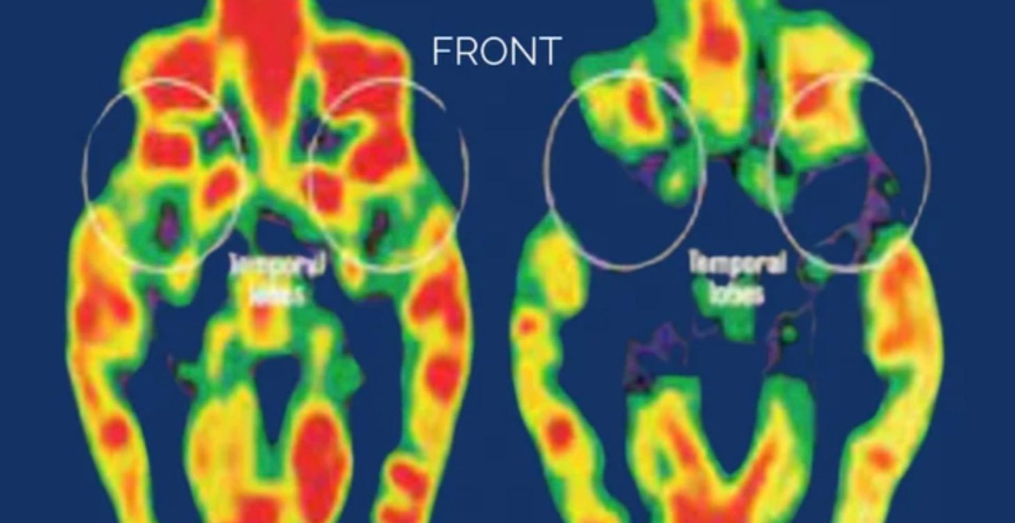 Resource: Healing the Brain After Loss