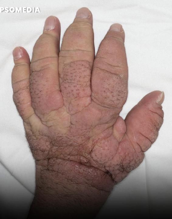 甲狀腺性杵狀指