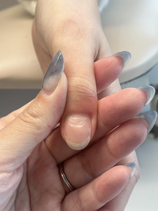 研判是摳手皮造成的