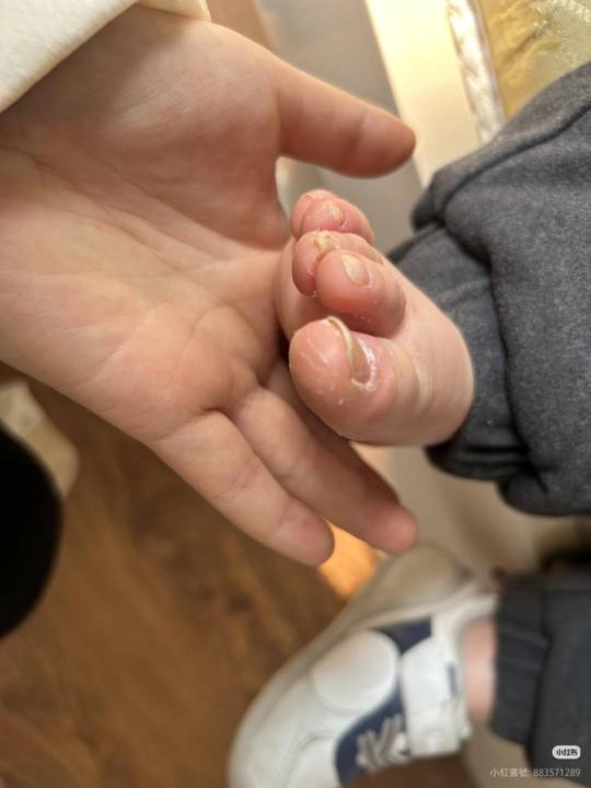 這片指甲，不是灰指甲