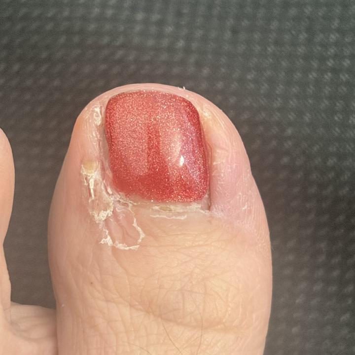 關於足部細菌感染