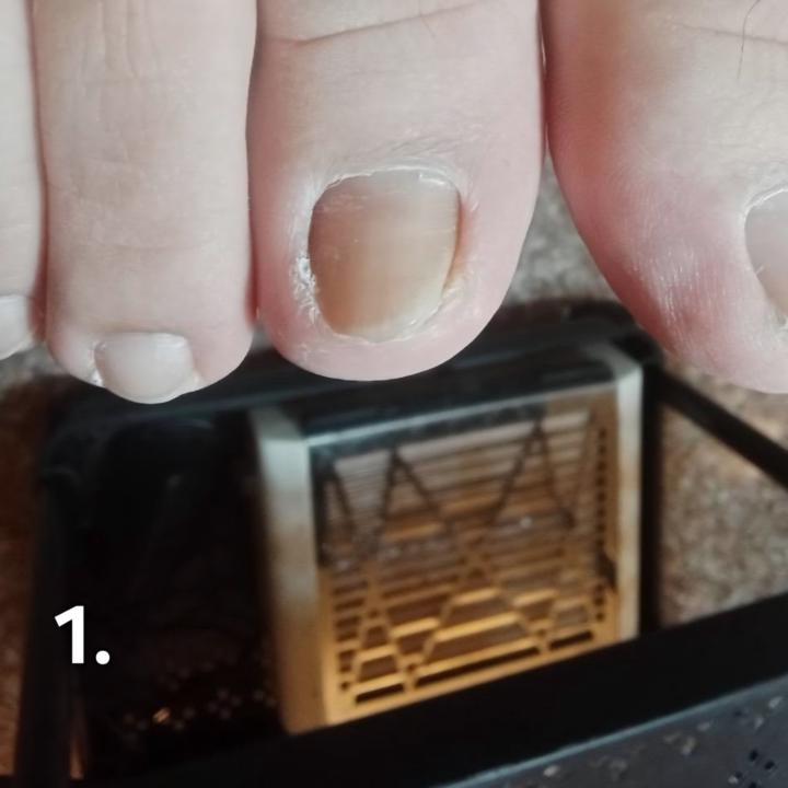 矯正做對了，但感染了...你覺得原因是？