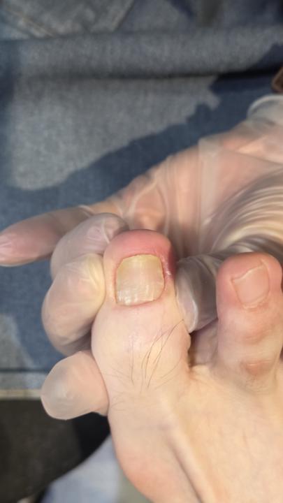 我擦灰指甲的藥都不會好...