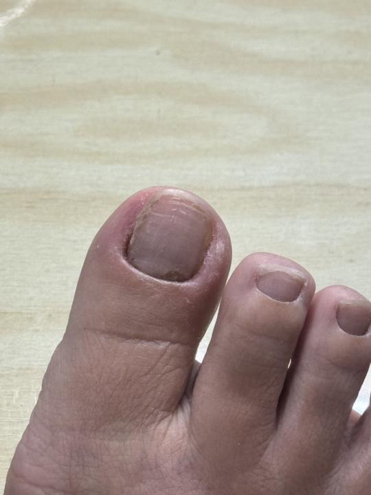 請問老師 這個客人的指甲狀況？