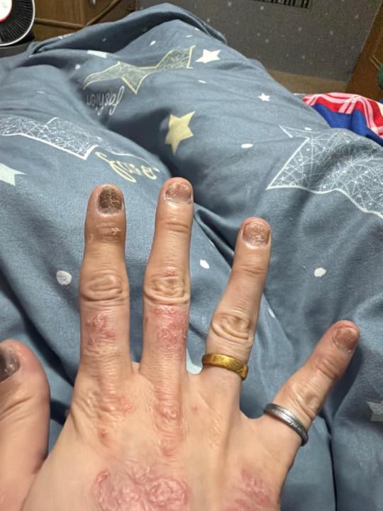 問題甲可施作凝膠上色嗎？