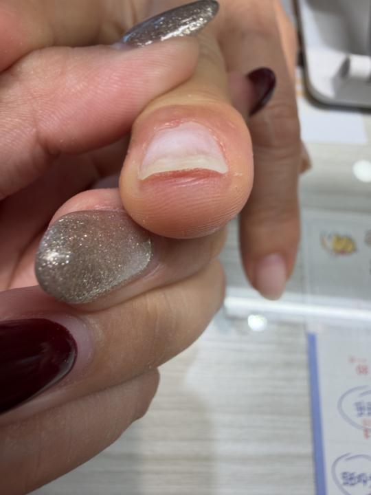 客人指甲長這樣有點凹凸 也不會痛想詢問這個是有什麼外在因素影響嗎？