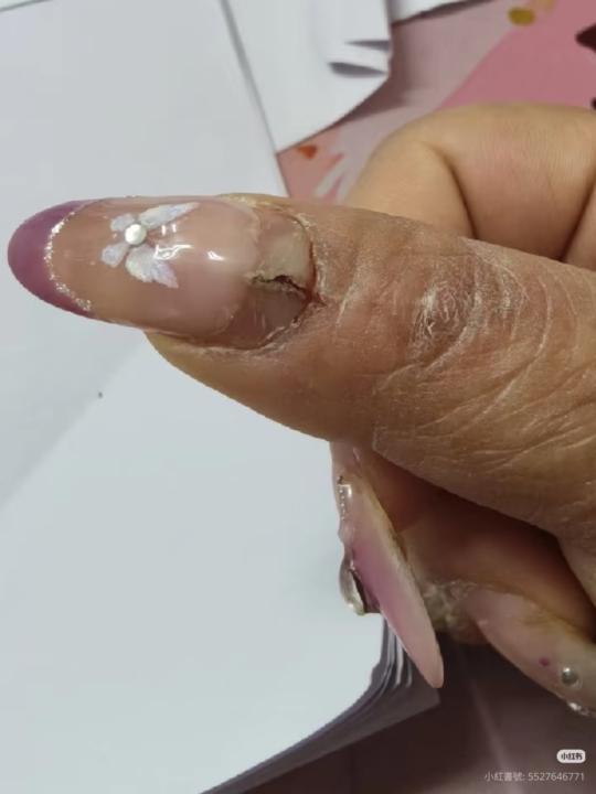 指甲根部裂開一條縫...