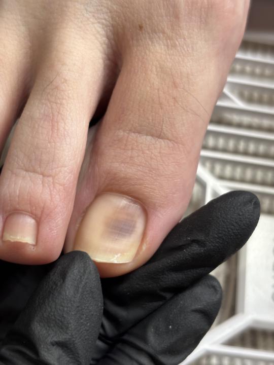 初步判斷是長期穿壓力襪導致