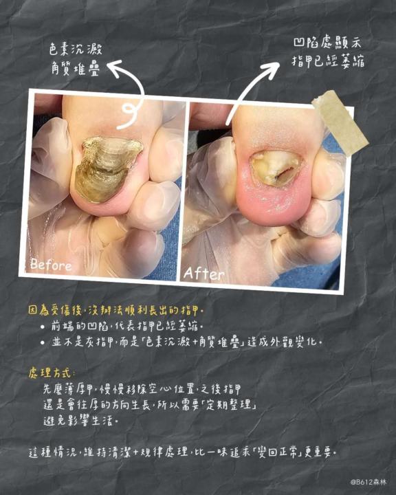 Q.這是灰指甲嗎？