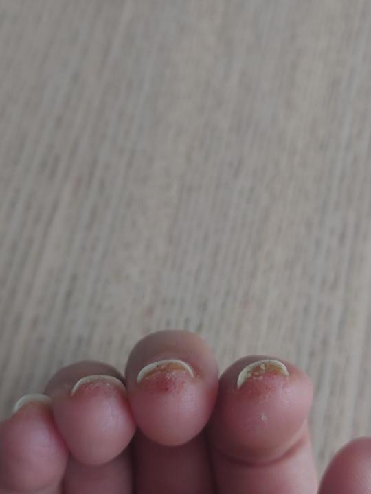 我這個甲床分離可以怎麼處理？