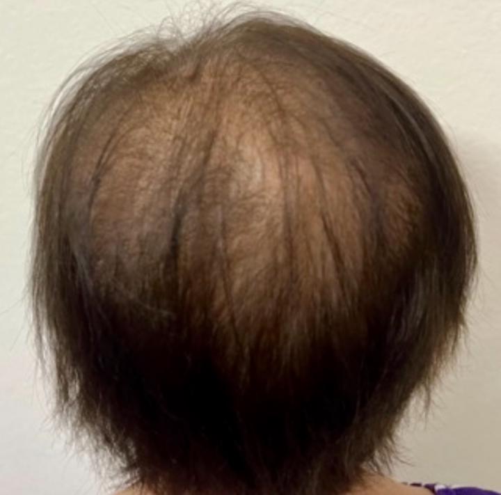 Cancer survivor after remission