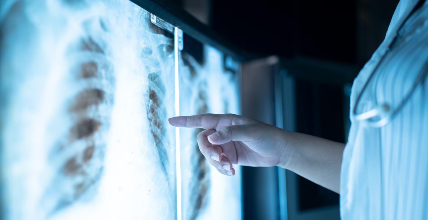 Detección de enfermedades a partir de RX de tórax