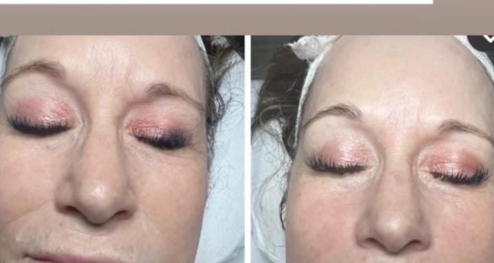 Microneedling  Aestheticians