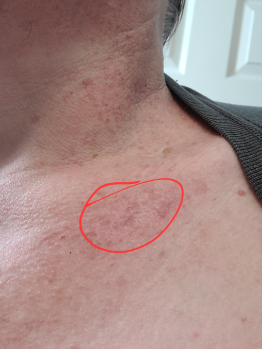 What Scar? - Follow up to Doug's Skin Cancer Victory