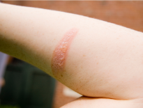 Burns and Scalds