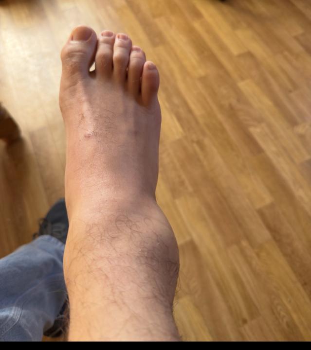 comment soigner une cheville et tendon pété ?